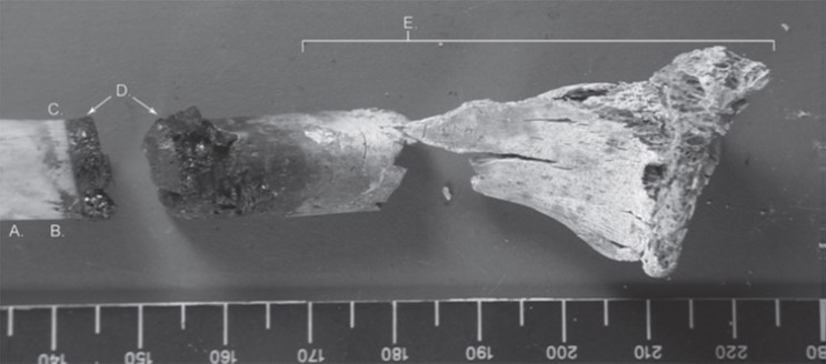 Figure 1. (a) Burn patterns on a single bone (Dirkmaat et.al 2012)